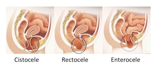Rectocele - Enterocele Treatment
